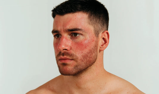 Rosacea, cuperosis y rojeces en hombres
